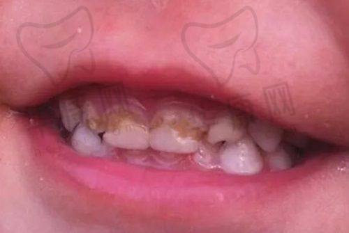 云南玉溪牙博仕口腔爱尔创全瓷冠价格的真实性分析