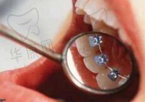 在宜兴金铂利口腔做隐适美隐形矫正一年，牙齿不齐、下巴后缩等问题全改善