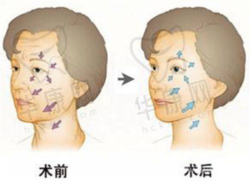 热拉提治疗的过程