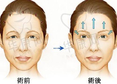 术后护理和修复情况如何影响3D生物束带缩阴成效持久度?
