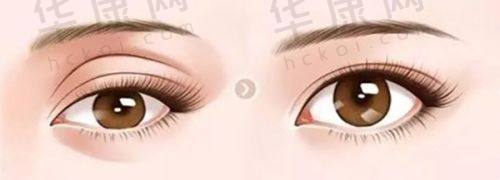 给想隆胸的姐妹们的建议
