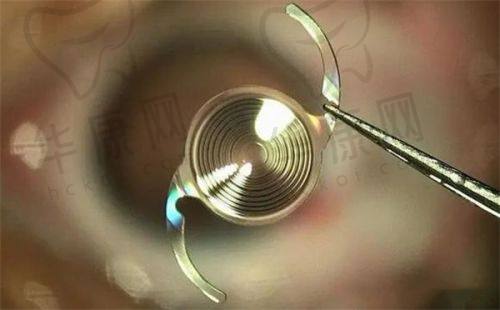 易被忽视的青光眼早期表现