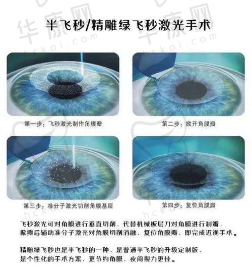 杭州茗视佳眼科在个性化半飞秒项目的特色