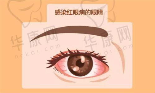 需要警惕的青光眼高危人群