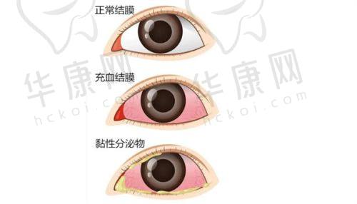 无锡华厦眼科医院ICL晶体植入手术的预约与询问