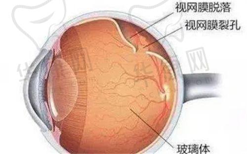 白内障手术价格考量