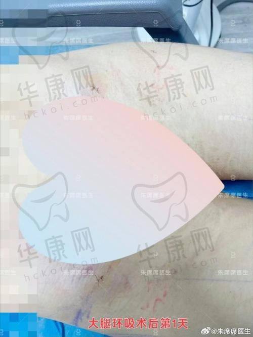 手术过程与体验