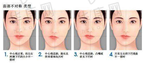 邹吉平医生在曼托假体隆胸手术中的优势