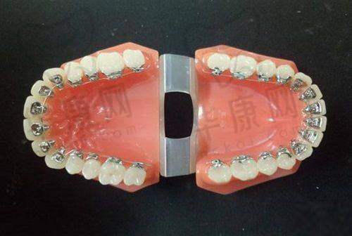 邯郸中科口腔全瓷嵌体补牙与其他机构的对比