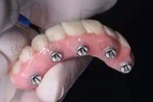 如何提高纯钛活动义齿佩戴的舒适度