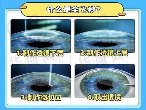 爱尔眼科2025近视手术价目表是怎样的?