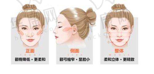 广州韩妃医疗美容医院杨熙雯大眼综合的成功实例