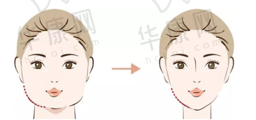 上海王洪医生如何用实力解决馒化脸问题?