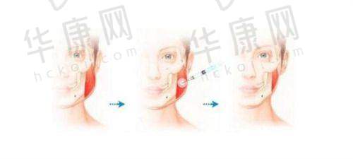 沈阳辽沈华美医院疤痕科的治疗项目