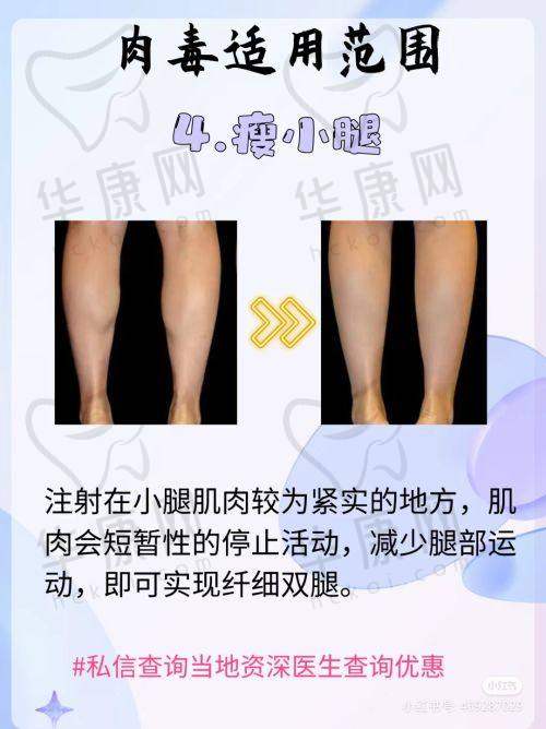 面部吸脂手术过程