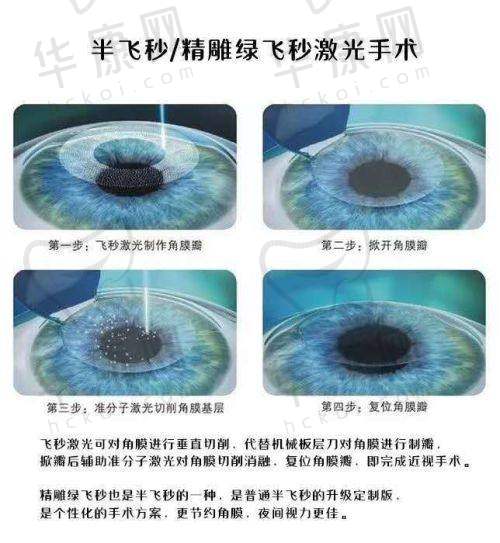 普瑞眼科和爱尔眼科医生技术谁更优?