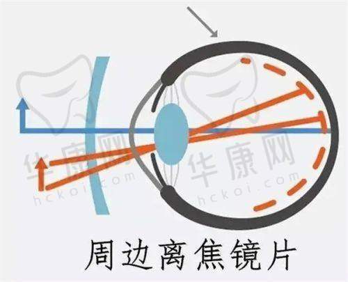 武汉普瑞眼科医院沈政伟术后的修复情况