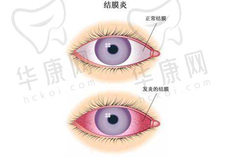 贵阳爱尔眼科医院全飞秒手术的技术优势