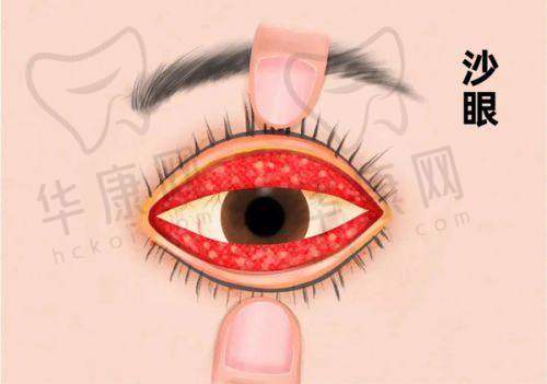 周口中视眼科医院国产角膜塑形镜的口碑与信誉优势