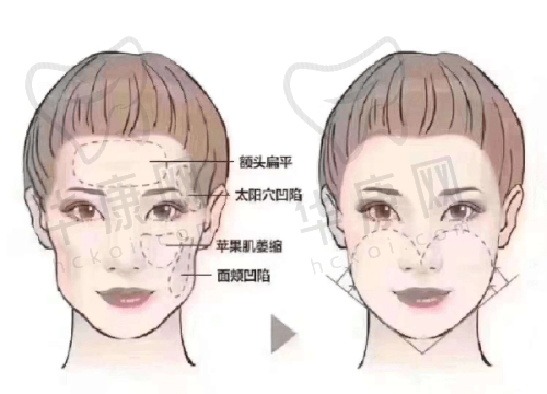 不同类型红血丝的治疗次数和成效预期是怎样的？
