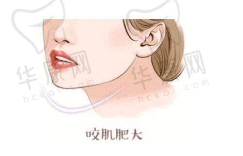 杨熙雯医生肋软骨鼻综合成功实例展示