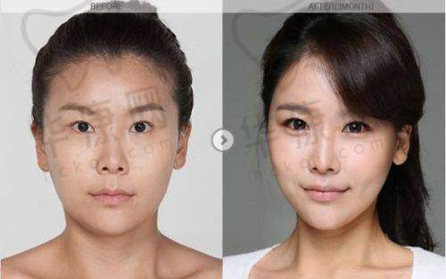 影响温州艺星双眼皮价格的因素