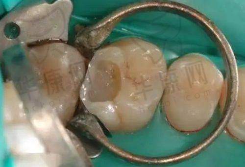 济宁任城玉红古槐口腔医生团队在美学树脂补牙方面的优势