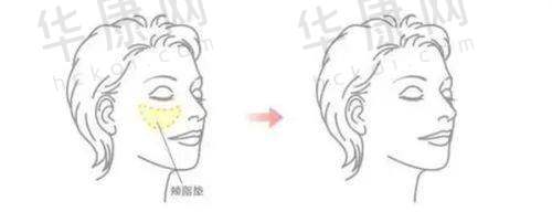 消费者对深圳米兰柏羽医疗美容医院半岛超声炮的反馈