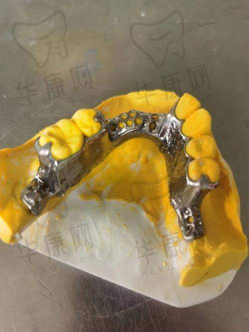 成都西南口腔医院半口活动义齿的患者反馈