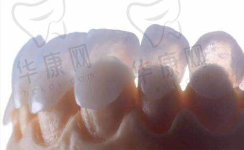 在常德好大夫口腔医院做瓷贴面美白，黄牙逆袭大白牙，开启自信笑容新旅程