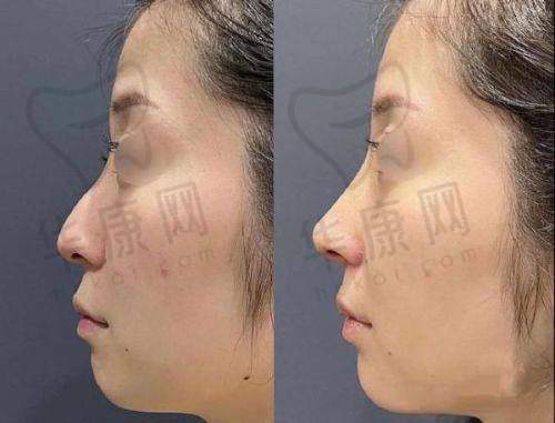 注射过程体验