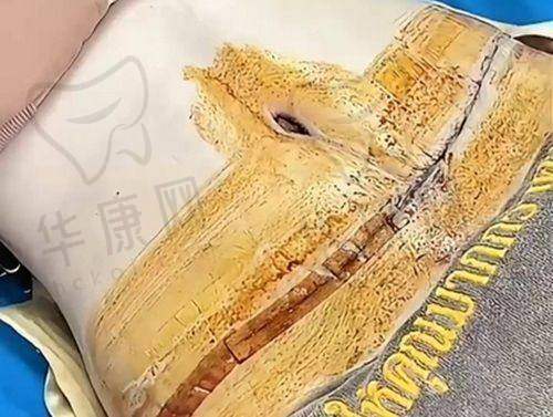 南京美莱和华美医生团队揭秘