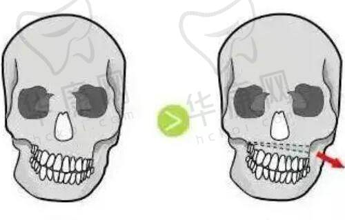 下巴截骨术同时改善后缩和宽的原理是什么？