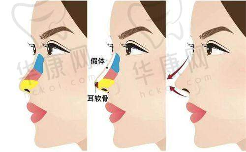 在深圳画美医疗美容医院找陈贞宜注射，从松弛暗沉到紧致焕颜太惊艳！