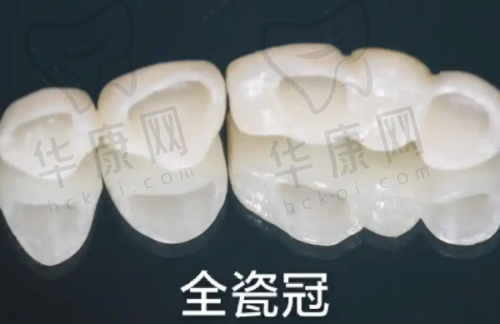 种植牙和镶牙有什么区别呢?