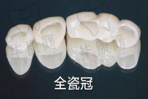 不同类型的常熟一院种植牙价格为何有差异?