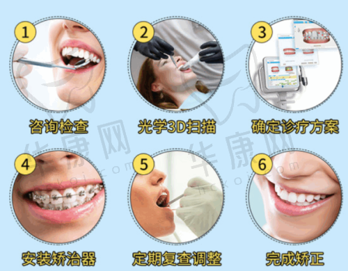 佩戴舌侧矫正器的体验