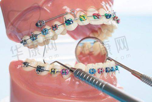 玉溪牙博仕口腔能做舌侧保持丝吗:技术优势解析