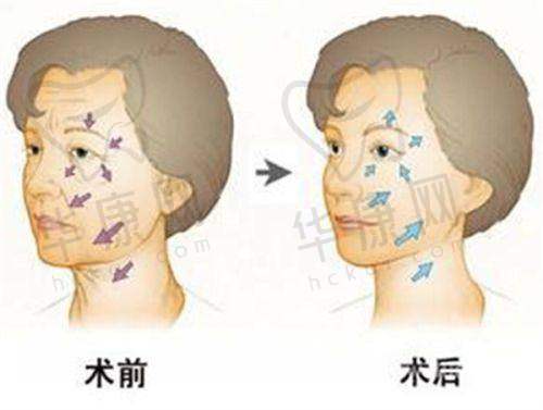 吕方中医生修复双眼皮口碑好，在广州新市医院坐诊，技术审美佳且预约便捷