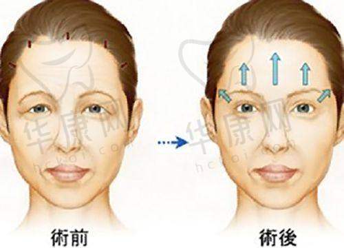 南京陈小剑擅长修复哪些失败双眼皮？