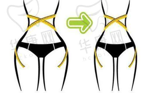 成都怡脂医院抽脂:个性化方案定制