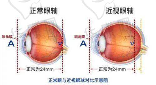 段安丽后巩膜加固术的患者评价和手术疗效怎样?