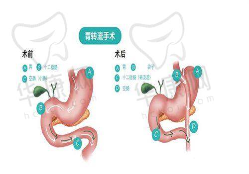 现代吸脂去副乳技术能减少皮肤松弛吗?