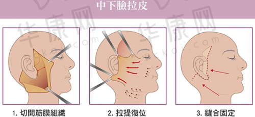 全息六维层离清奥技术能做到干净清除吗？