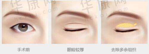 深圳美莱医院是哪个地铁站，深圳美莱整形怎么样？交通便利隆鼻优值得选