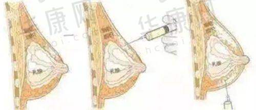 5. 成都米兰柏羽医疗美容