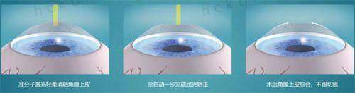 2025年邢台近视眼手术哪家医院强？6家实力医院各有优势，助你摘镜无忧