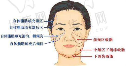 术后成效:自然柔软似天生