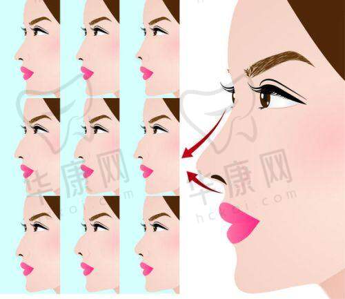 重庆美仑美奂医院隆鼻的综合实力