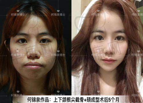 上睑凹陷自体脂肪填充,填充脂肪的质量和数量对成效有什么影响?